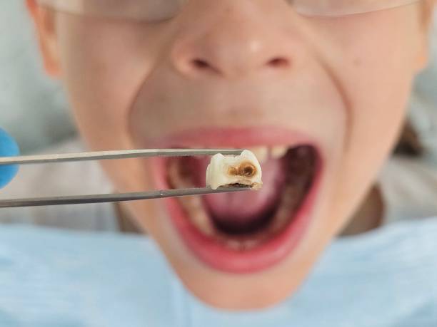Best Emergency Dentist for Lost Fillings or Crowns in Franklinton, LA